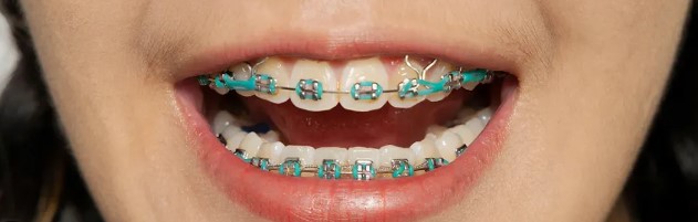 Do I Need To Get Braces?