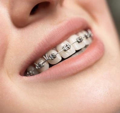Do I Need To Get Braces, require braces, necessitate orthodontic treatment, should I get braces, seeking orthodontic help, orthodontic evaluation, dental misalignment concerns, seeking a beautiful smile, considering orthodontic care, pondering braces, contemplating teeth alignment, exploring braces candidacy, wondering about dental alignment, assessing braces benefits, examining orthodontic options, evaluating dental alignment, curious about braces, teeth straightening, deciding on braces, inquiring about orthodontic treatment, discussing braces, orthodontic consultation, exploring teeth alignment, considering orthodontic solutions, teeth correction considerations